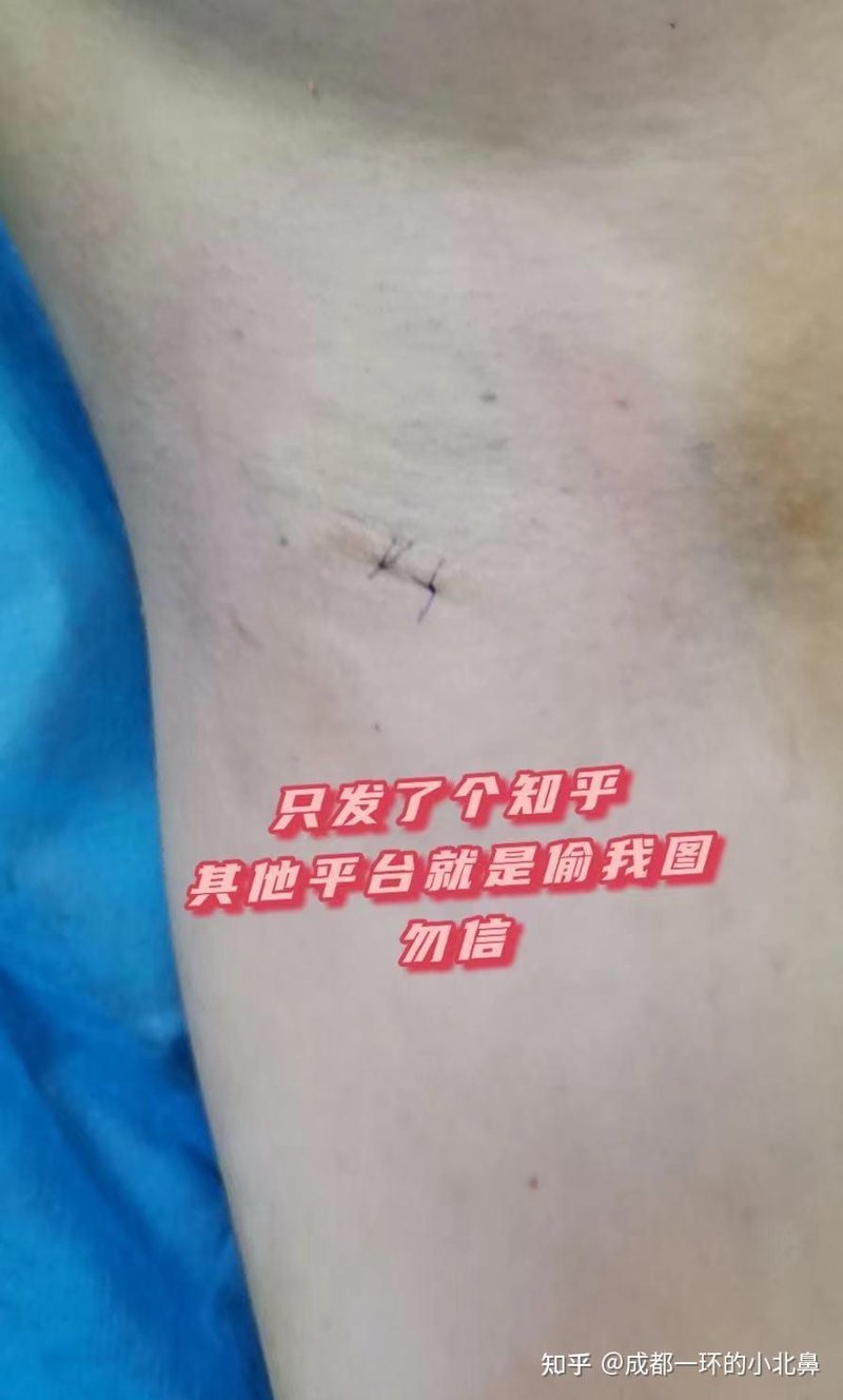 治疗狐臭哪家医院好?选择适合自己的治疗方案