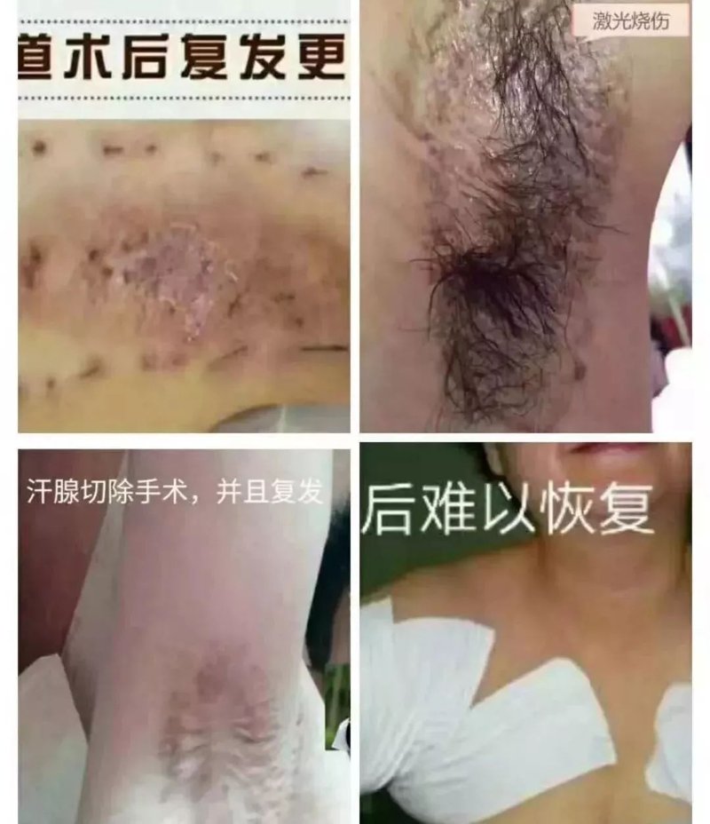 腋下异味困扰，手术解除烦恼