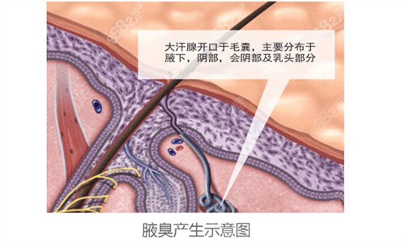 狐臭微创手术:悄然颠覆传统治疗方式